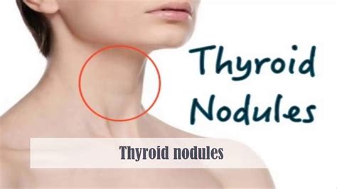 Solitary Thyroid Nodule Causes Symptoms Diagnosis Treatment And Prognosis