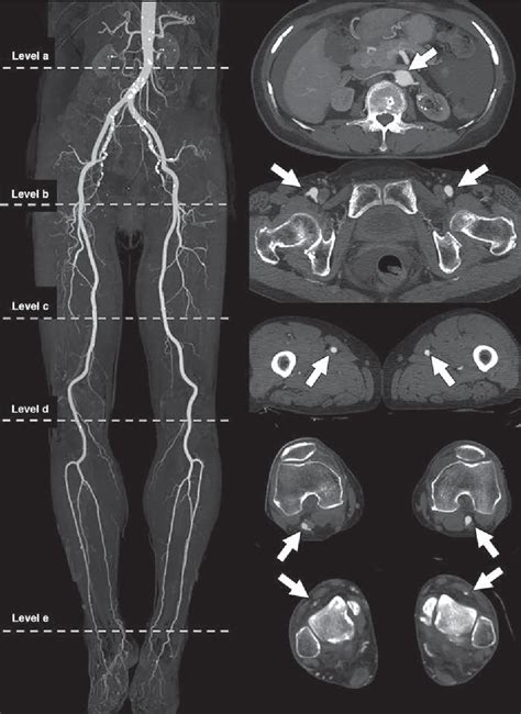 Figure 1 From Ct Angiography Of Suspected Peripheral Artery Disease