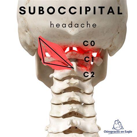 Cervicogenic Headaches Chiropractic On Eagle Dr Jon Saunders