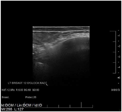 Sonographic Confirmation Of Intracapsular And Extracapsular Breast