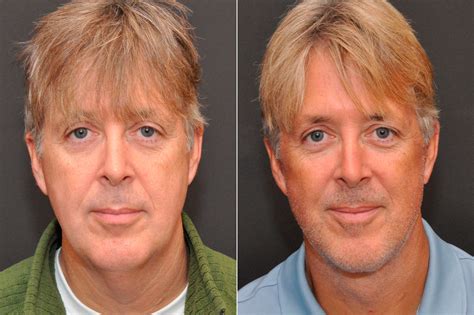 Celebrity Male Plastic Surgery Before And After Photos