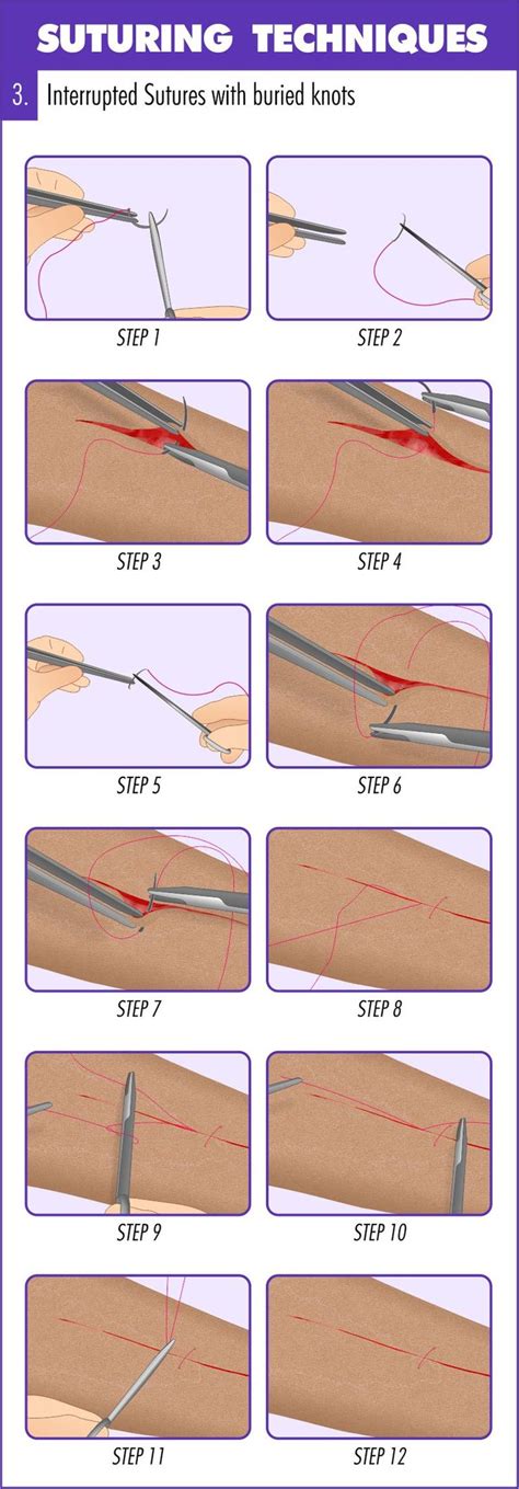 Complete Guide To Mastering Suturing Techniques Suturing Techniques