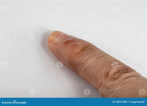 Ganglion Cyst On Finger Stock Image Image Of Lump Cyst 108413987