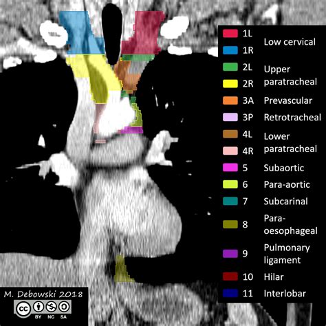 Thoracic Lymph Node Stations Annotated Ct Image