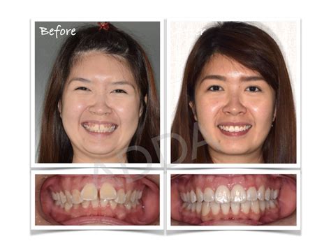 Invisalign Before And After Case Study 8 Adda