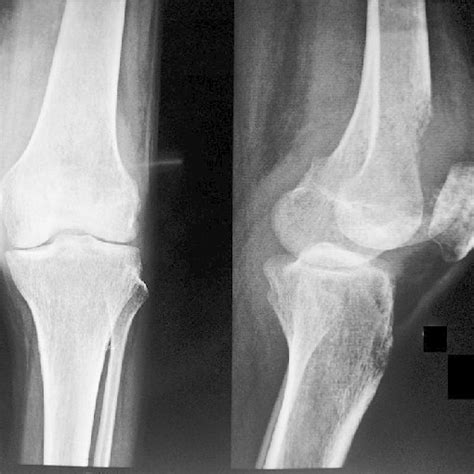 X Ray Knee Joint Anteroposterior And Lateral View Showing Lytic Lesion