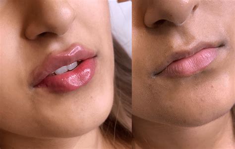 Juvederm Lip Enhancements At Charmelle London Lip Fillers