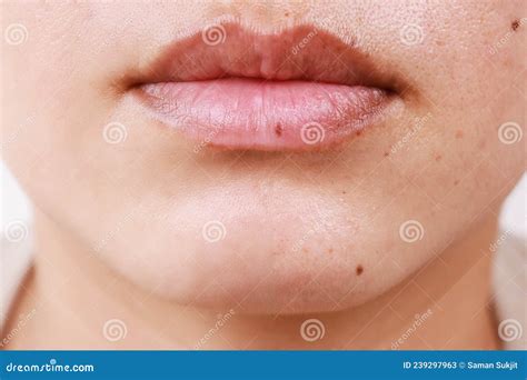 Medical Treatment Freckles Spots On The Face And Mouth Female Stock