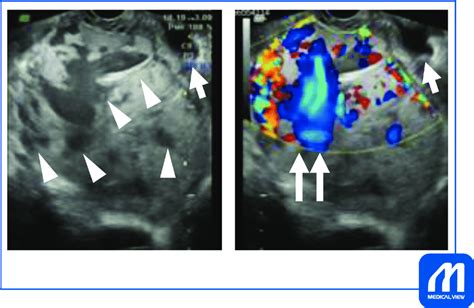 Transvaginal Ultrasonography Showing Placenta Percreta With Urinary Download Scientific Diagram