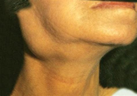 Swollen Neck Glands May Represent Cancer Indiatv News Lifestyle News
