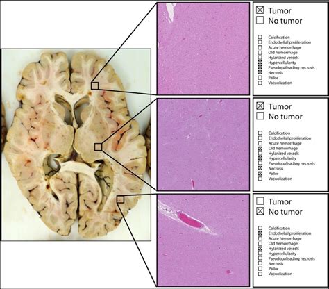 Table 1 From Pathologically Validated Tumor Prediction Maps In Mri