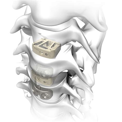 Espaçador Intervertebral Cervical Rebar Atlas Spine Via Anterior Em Peek