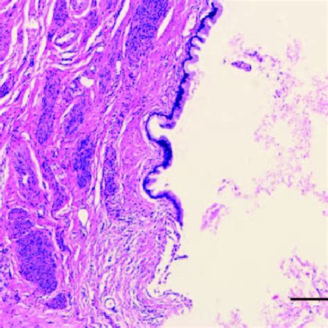 Pdf A Large Nabothian Cyst Causing Chronic Urinary Retention A Case