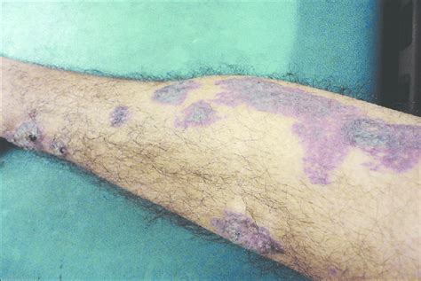 Verrucous Hemangioma Lesions In Different Stages Of Evaluation—early