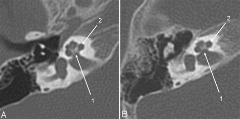 Low Dose Temporal Bone Ct In Infants And Young Children Effective Dose