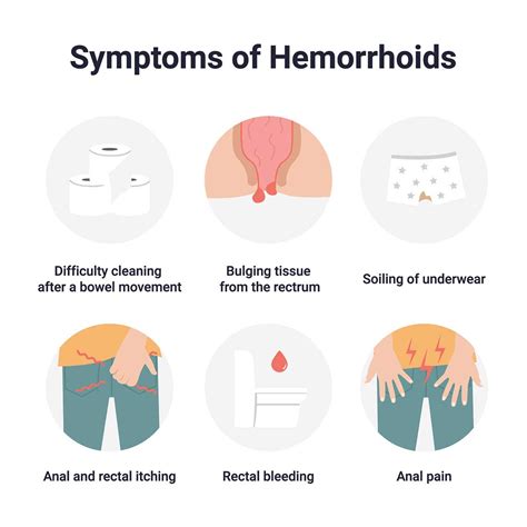 Prolapsed Hemorrhoid Vs External