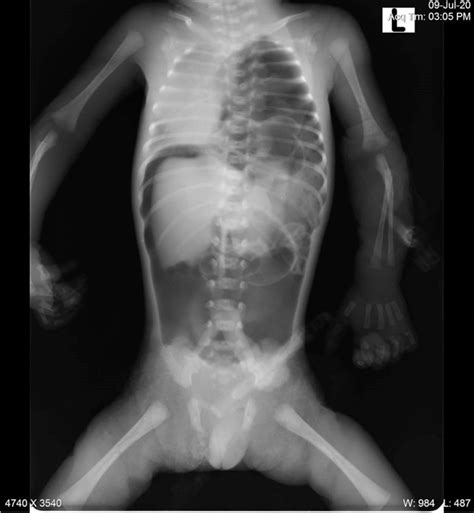 Pneumoperitoneum In A Neonate With Congenital Diaphragmatic Hernia