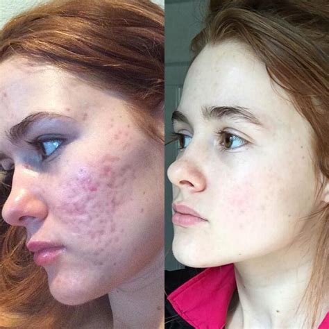 Dermarolling Before And After Pics Dermarolling For Scars And Acne