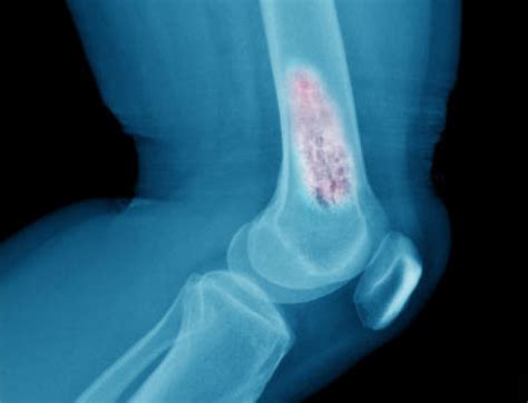 हड्डियों में कैसे हो जाता है कैंसर What Is Bone Cancer And How To Deal With It The