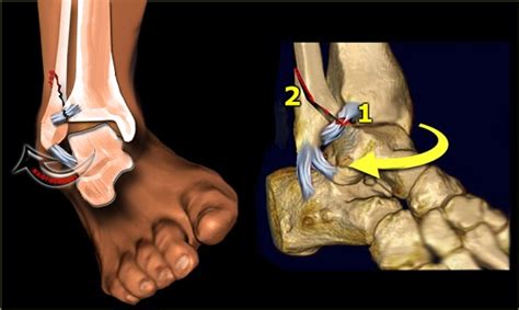 Avulsion Fracture Ankle Treatment Doctorvisit