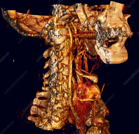 Neck Anatomy 3d Ct Scan Stock Image P2060430 Science Photo Library