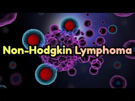 Non Hodgkin Lymphoma Updated Crash Medical Review Series