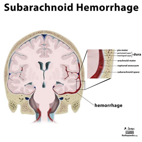 Subarachnoid Hemorrhage Pathophysiology Wikidoc