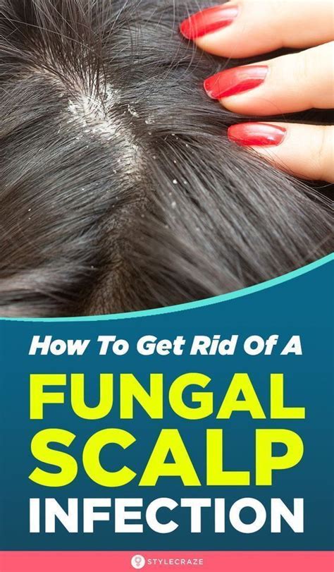 Scalp Yeast Infection Treatment Wedding Ideas You Have Never Seen Before