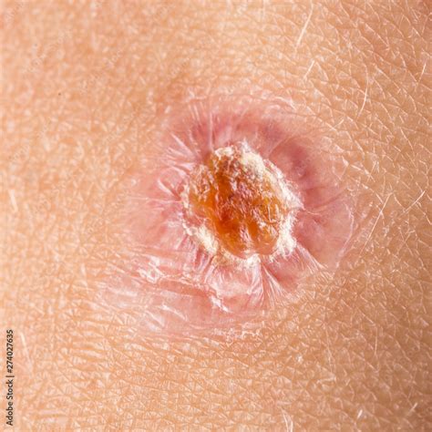 Top 90 Pictures What Does An Infected Wound Look Like Pictures Excellent