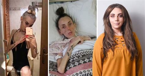 Anorexia Survivor Who Weighed Just 4st Shares Inspiring Recovery Story