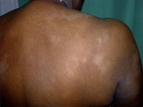 A Study Of Clinicopathologic Profile Of 15 Cases Of Hypopigmented