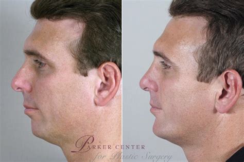 Chin Implant Before And After Pictures Case 116 Paramus Nj Parker
