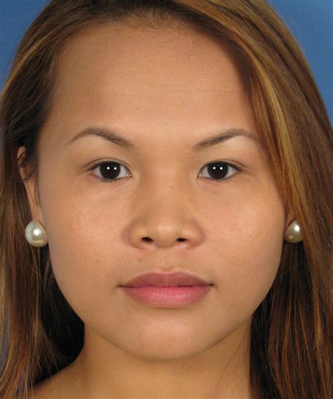 Asian culture, the culture of the people from asia. Asian Rhinoplasty