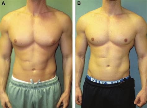 Image Idea Coloring Bodybuilder Gynecomastia Surgery Before And After