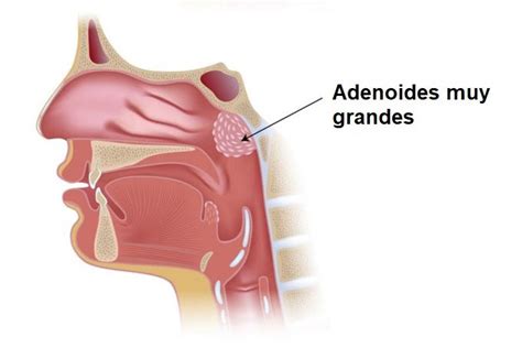 Hipertrofia De Adenoides ¿qué Son Las Adenoides Y Cual Es El Tratamiento