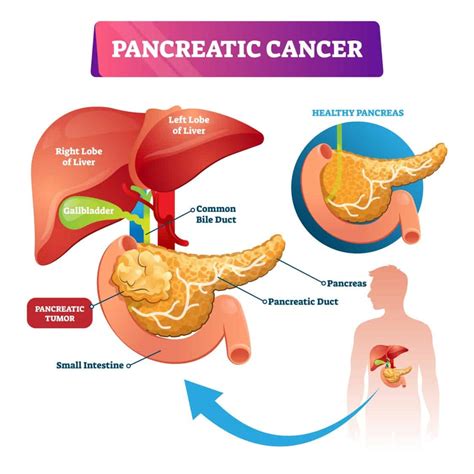 Pancreatic Cancer Illustration Medicare Solutions Blog