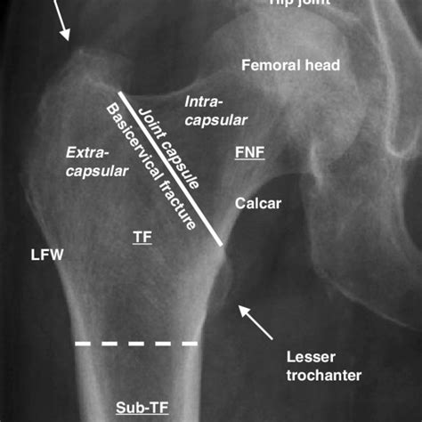 Axial Distal Femur