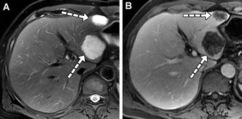 Liver Metastases Correlation Between Imaging Features And