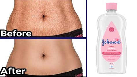 In 3 Days Remove Stretch Marks Completely World S Best Remedy For