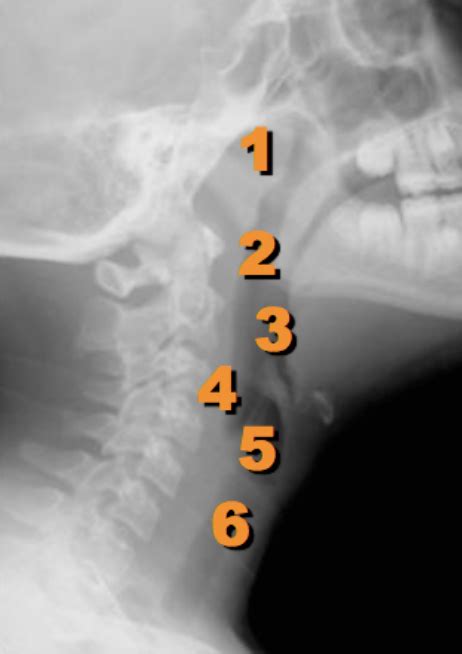 Soft Tissue Neck Radiographs — Taming The Sru