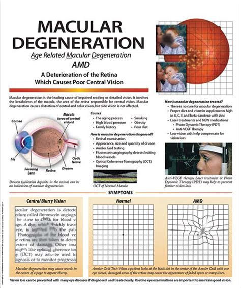 Patient Education Poster Macular Degeneration