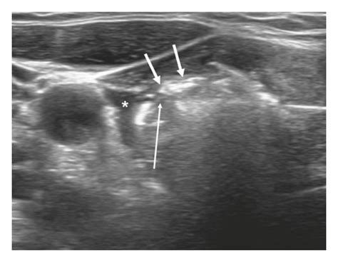 A Benign Symptomatic Thyroid Nodule In A 36 Year Old Female Treated