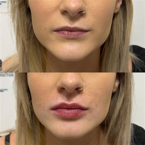 Natural Lips Facial Fillers Botox Fillers Botox Before And After