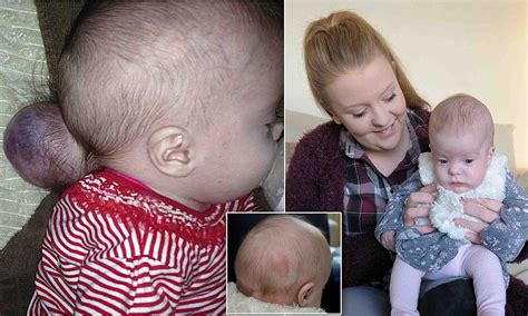 Baby Girl Born With Part Of Her Brain Outside Her Skull Defies Doctors