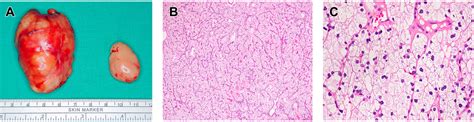 Double Water Clear Cell Parathyroid Adenoma A Case Report And