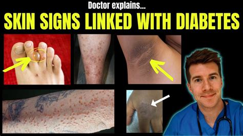 Doctor Explains 12 Skin Conditions Associated With Diabetes Youtube