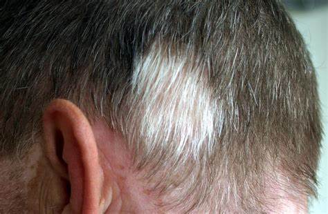 What Is Poliosis? Causes And Treatment