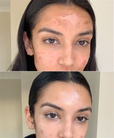 Medical Grade Skin Peels Before And After Images Infinity