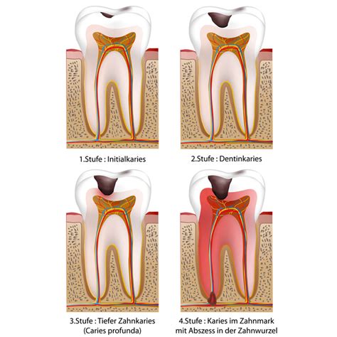 Wenn karies so weit vorgedrungen ist und sogar das innere des zahns entzündet ist, ist dies gefährlich. Wie wird Karies behandelt? | Kostenfalle Zahn