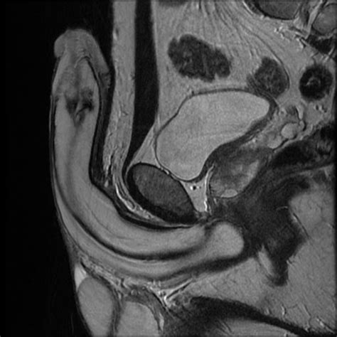Radiology Cases Penile Fibrosis Dd Peyronie Disease